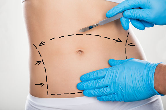 Abdominoplastik Baden-Baden