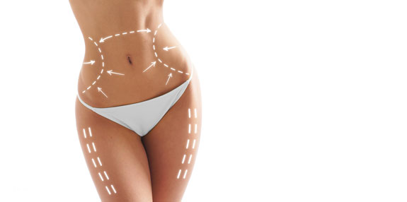 Liposuktion Baden-Baden